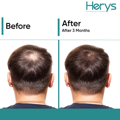 Herys Rosemary Hair Growth Serum | 3% Redensyl &amp; Anagain | 30ml